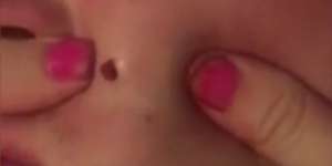 Empat Tahun Bintil di Pipi, Saat Dipecahkan Isinya...