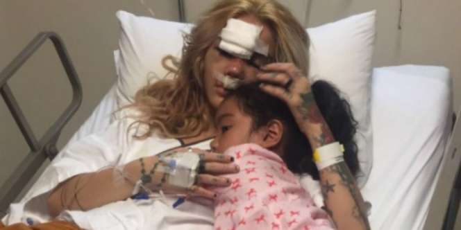 Sheila Marcia Tak Mau Buru-buru Operasi Hidung Retak, Ada Apa?