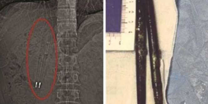 Seram, Benda Ini Menghuni Perut Selama 36 Tahun
