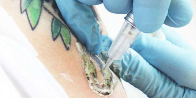 Niat Hapus Tato Berujung Tragis