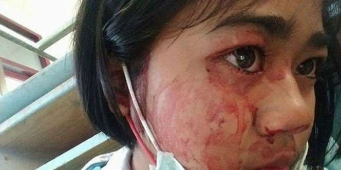 Gadis Ini Nangis Darah Tiap Sakit Kepala, Ternyata Sebabnya...