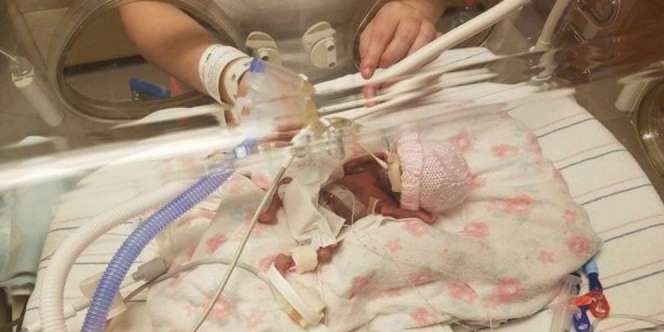 Di Kandungan 23 Minggu, Saat Lahir Bayi Panjangnya Hanya 22 Cm