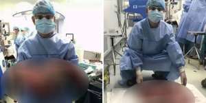 Dokter Angkat Kotoran Seberat 12,7 Kilogram dari Usus Pria Ini