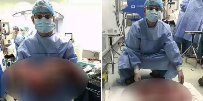 Dokter Angkat Kotoran Seberat 12,7 Kilogram dari Usus Pria Ini
