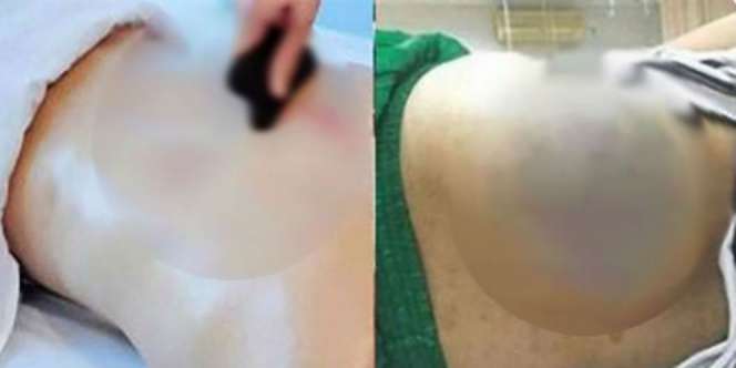 Habis Dikerok, Muncul Benjolan Raksasa di Punggung Wanita Ini