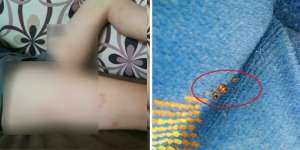 Pergi Naik Bus, Kaki Si Cewek Dipenuhi Tanda Merah Mengerikan