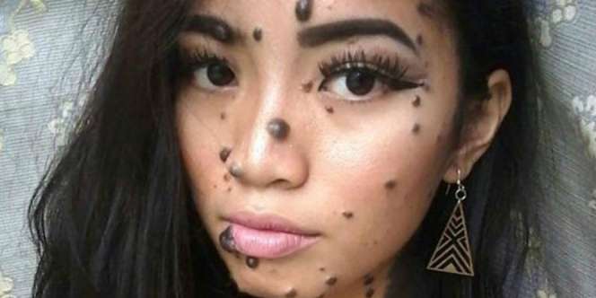 Dulu Dibully karena Punya Tahi Lalat di Sekujur Tubuh, Kini..