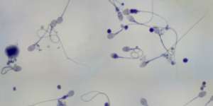 Mengenal Azoospermia, Pemicu Kemandulan Pria