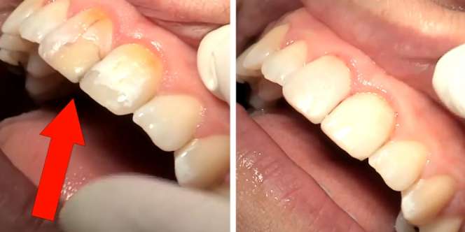 Ajaib! Gigi Rusak dan Kuning Kembali Putih dalam 90 Menit