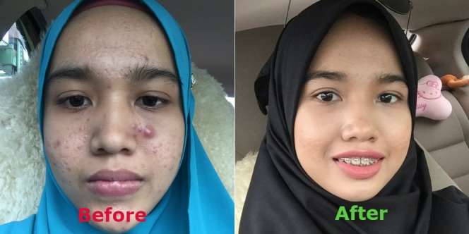 Dulu Wajah Penuh Jerawat Batu, Bisa Cantik Hanya dalam 4 Bulan