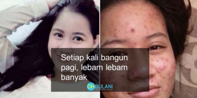 Berjerawat Mengerikan, Wanita Ini Mengaku Kena `Ilmu Hitam`