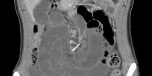 Sakit Perut Parah, Dokter Syok Temukan Ini di Perut Pasien