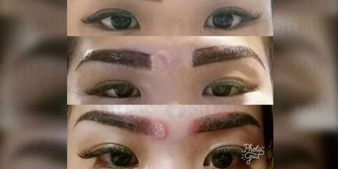 Sulam Alis Berujung Luka Mengerikan