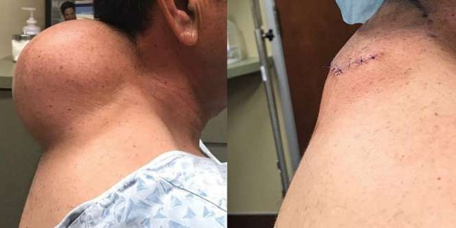 Geger Bedah Jerawat Raksasa Paling Menjijikan