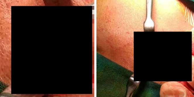 Wajah Pria Ini Jadi Sarang Cacing Sepanjang 10 Cm