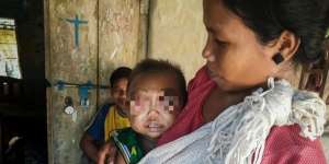 Nasib Bocah Bermata 'Jumbo'