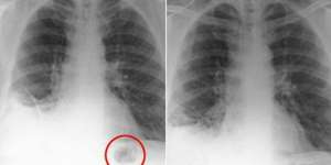 Ada Segitiga di Paru-paru Selama 40 Tahun, Saat Dibedah...