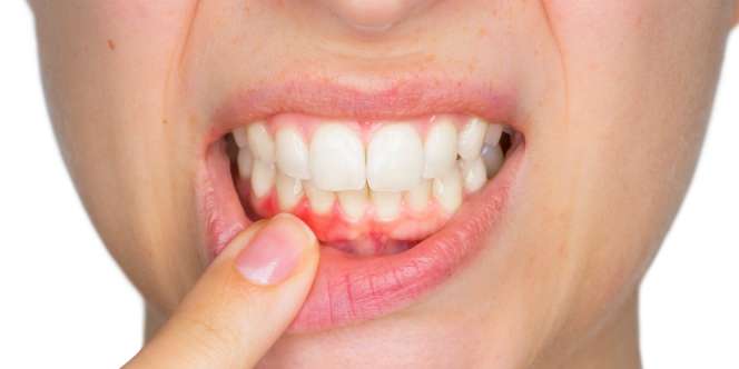 Awas! Periodontitis Ancam Nyawamu