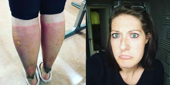 Sepelekan Sunscreen, Pelari Ini Alami Hal Mengerikan