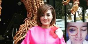 Geger Mata Lebam Pedangdut Nini Carlina