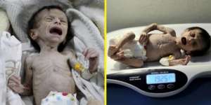 Tinggal Tulang Berbalut Kulit, Nangis pun Tak Mampu