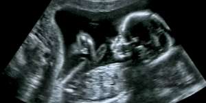 Viral! Pemuda di Grobogan Hamil, Saat Dioperasi Bayinya...