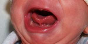 4 Gejala Tongue Tie yang Harus Diwaspadai