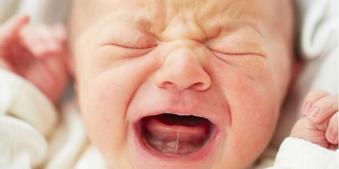 Operasi Tongue -Tie Pada Bayi Bisa Dilakukan Jika...
