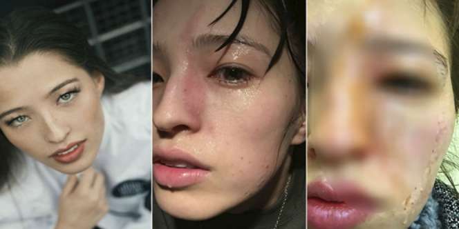 Kesemprot Uap Minyak Esensial, Mata Gadis Muda Rusak Permanen