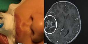 Komedo di Hidung Dipencet Ibu, Si Anak Alami Hal Mengerikan