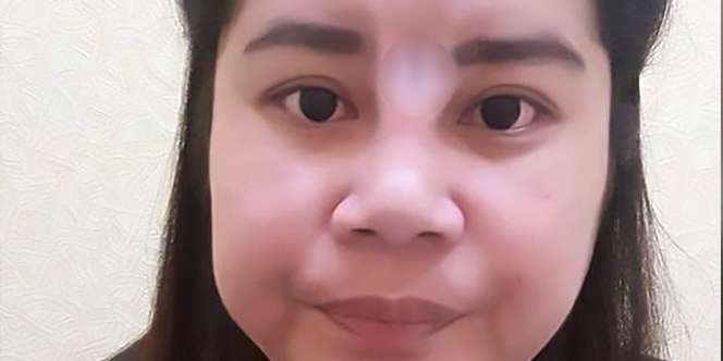 Ingin Mancung, Hidung Wanita Ini Malah Berlubang Mengerikan