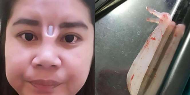 Ingin Lebih Mancung, Benda Mengerikan Tusuk Hidung Cewek Ini
