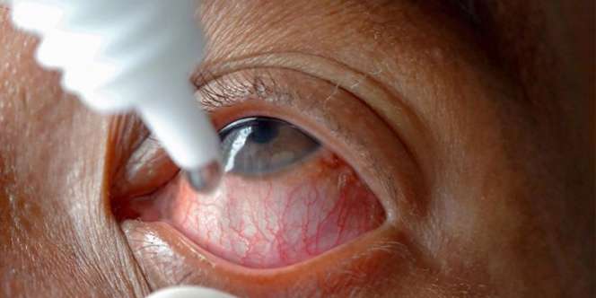 Ngeri! Lem Cair Dikira Obat Tetes, Mata Tak Bisa Dibuka