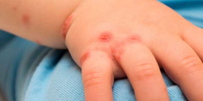 Impetigo, Penyakit Kulit yang Sangat Mudah Menulari Si Kecil