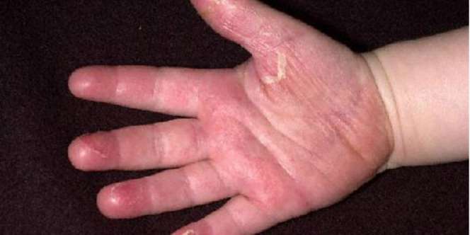 Kawasaki, Penyakit yang Sering Dikira Campak dan DBD