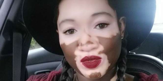 Derita Penderita Vitiligo, Habiskan 45 Menit untuk Rias Wajah