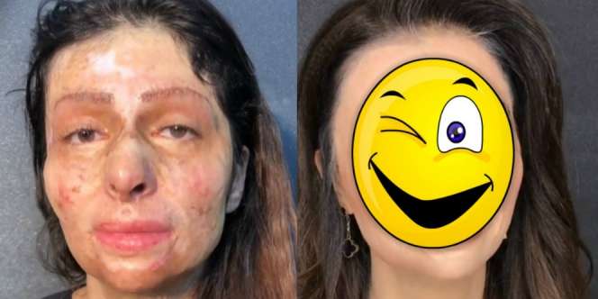 Korban Kecelakaan Menangis Saat Dirias Jadi Super Cantik