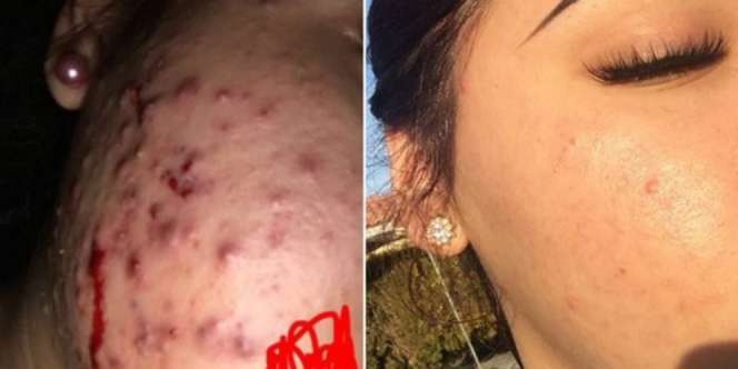 Kisah Viral Remaja Sembuhkan Jerawat Tahunan Hanya dengan Teh