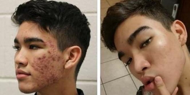 Jerawatan Parah, Remaja Ini Punya Trik Keren Mengatasinya