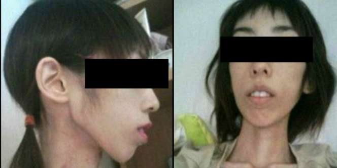 Disiksa Setiap Kali Makan, Gadis Ini Kurus Seperti Zombie