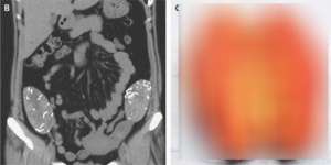 Perut Terasa Kembung Bertahun-tahun, Setelah Diperiksa...
