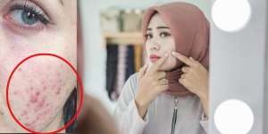Jerawat Membandel 15 Tahun Akhirnya Sembuh, Begini Caranya