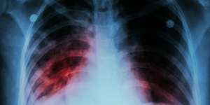 Batuk Lebih dari 2 Minggu? Bisa Jadi Terserang TBC