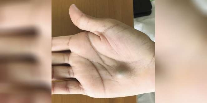 Ada Benjolan Merah di Telapak Tangan? Hati-hati Bisa Mematikan