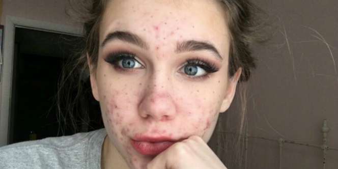 2 Tahun Konsumsi Obat Jerawat, Gadis Cantik Ini Terancam Buta