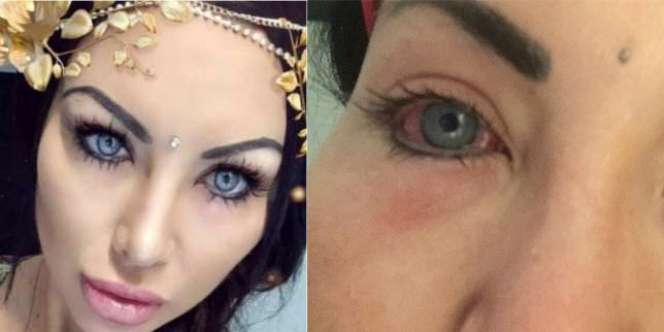 Ingin Punya Mata Indah, Model Ini Nyaris Buta Selamanya