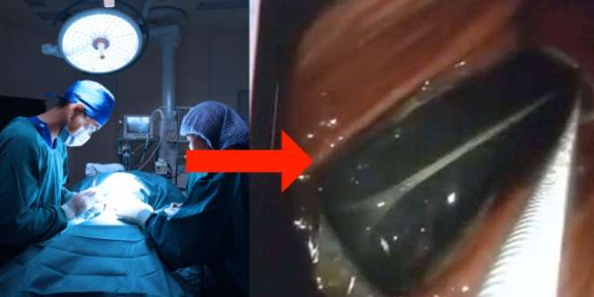 20 Tahun Sakit Perut, Usai Diperiksa Dokter Tercengang