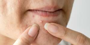 9 Tahun Berjerawat, Sembuh dalam 4 Bulan dengan Obat Ini