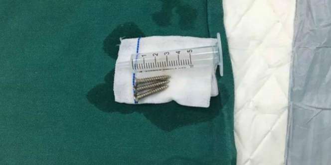 Ngeri! Bayi 37 Hari Telan Tiga Paku Tajam