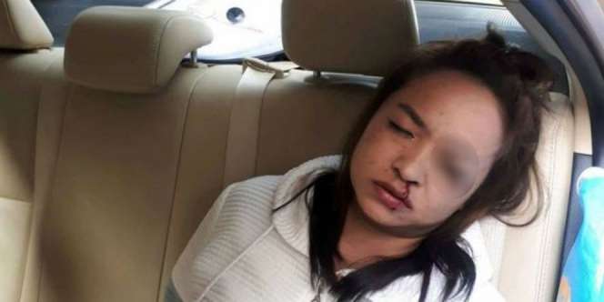 Ngeri, Wanita Ini Nyaris Buta Saat Rias Mata di Mobil